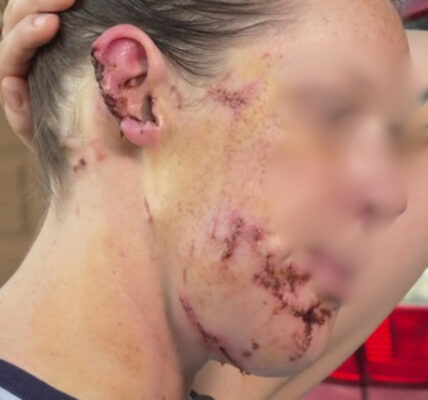 Vrouw uit Haarlem Overleeft Bizarre Hondaanval: “Ik Had Nooit Gedacht Dat Hij Mij Zou Doden”